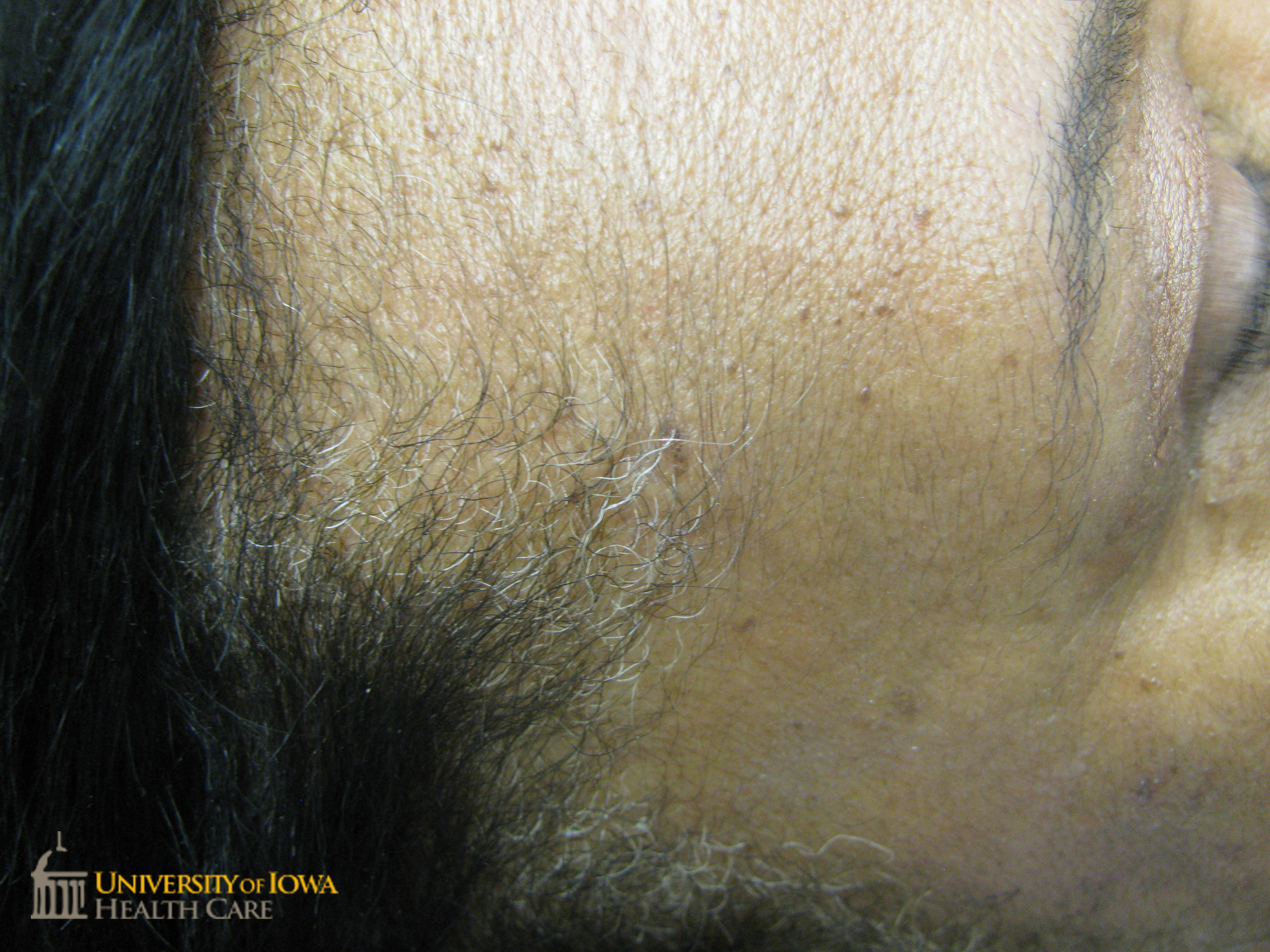 Multiple stuck-on brown papules on the forehead. (click images for higher resolution).